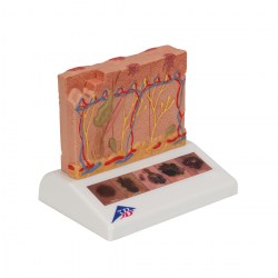 J15_02_1200_1200_Модель-рака-кожи-3B-Smart-Anatomy