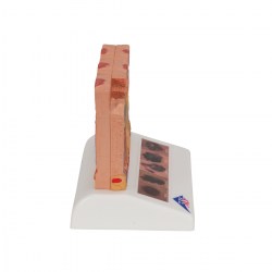 J15_03_1200_1200_Модель-рака-кожи-3B-Smart-Anatomy