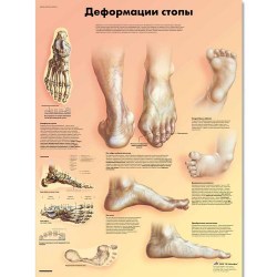 VR6185L_01_Медицинский-плакат-Деформация-стопы