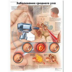VR6252L_01_Медицинский-плакат-Заболевания-среднего-уха