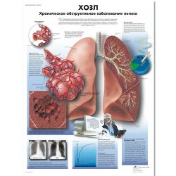 VR6329L_01_Медицинский-плакат-ХОЗЛ-хроническое-обструктивное-заболевание-легких