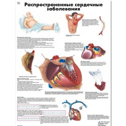 VR6343L_01_Медицинский-плакат-Распространенные-сердечные-заболевания