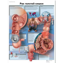 VR6432L_01_Медицинский-плакат-Рак-толстой-кишки